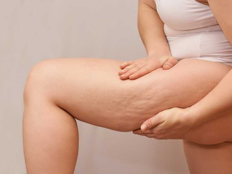 como afecta el estres a la aparicion de la celulitis