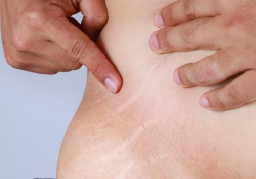 como se quitan las estrias con laser