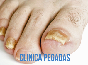 como se tratan los hongos en las unas de los pies