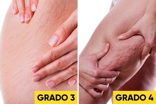 cuanto tiempo se tarda en eliminar la celulitis