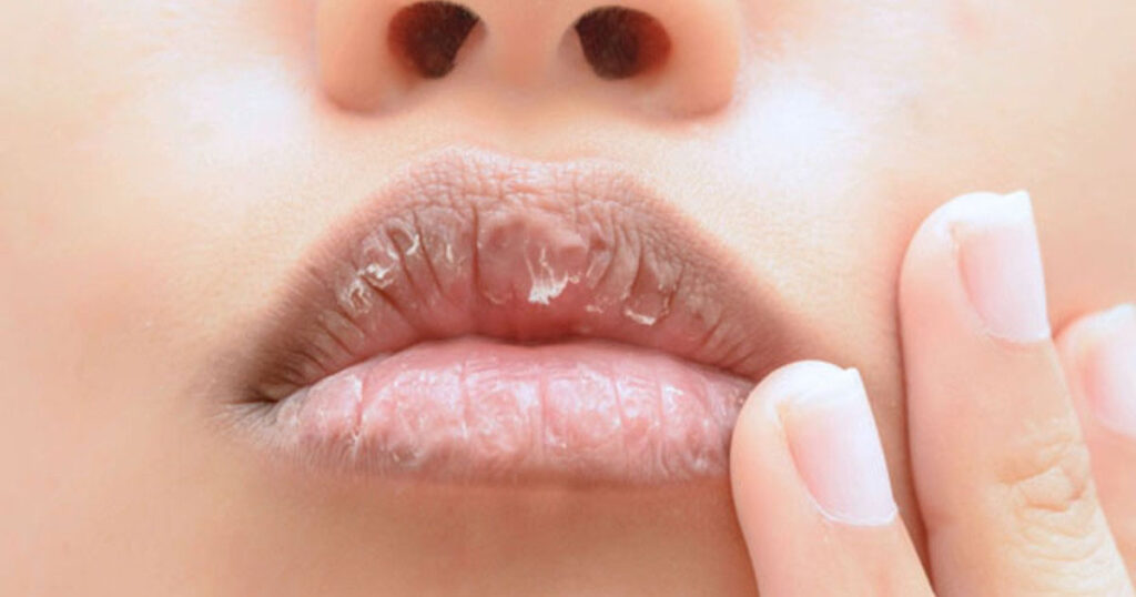 enfermedad que hace que los labios se resequen