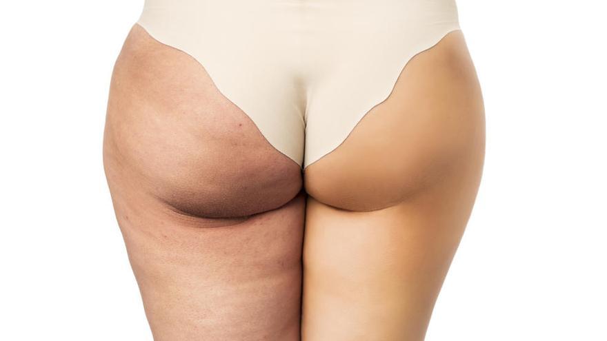 la celulitis es mas comun en mujeres que en hombres