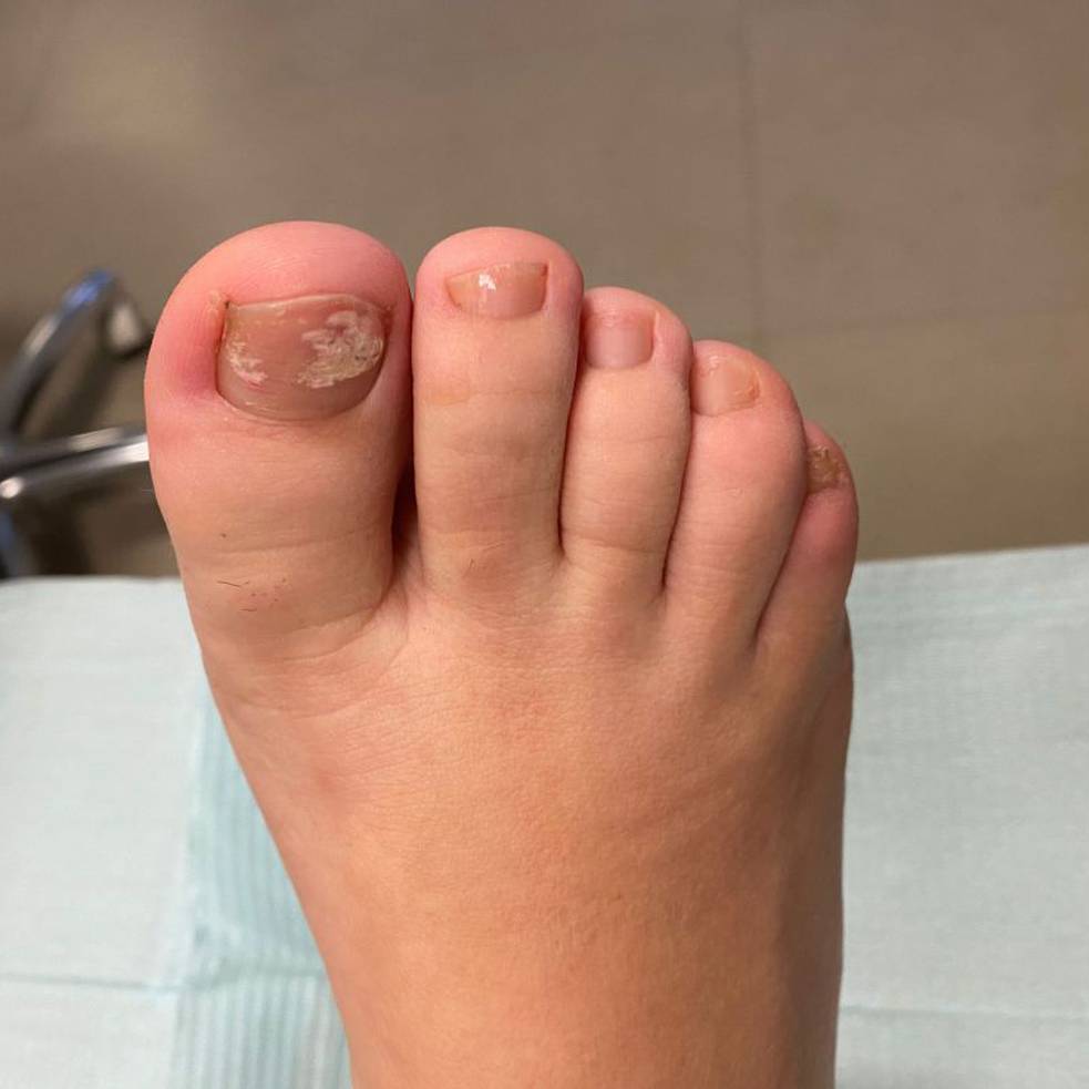 limado de unas con hongos
