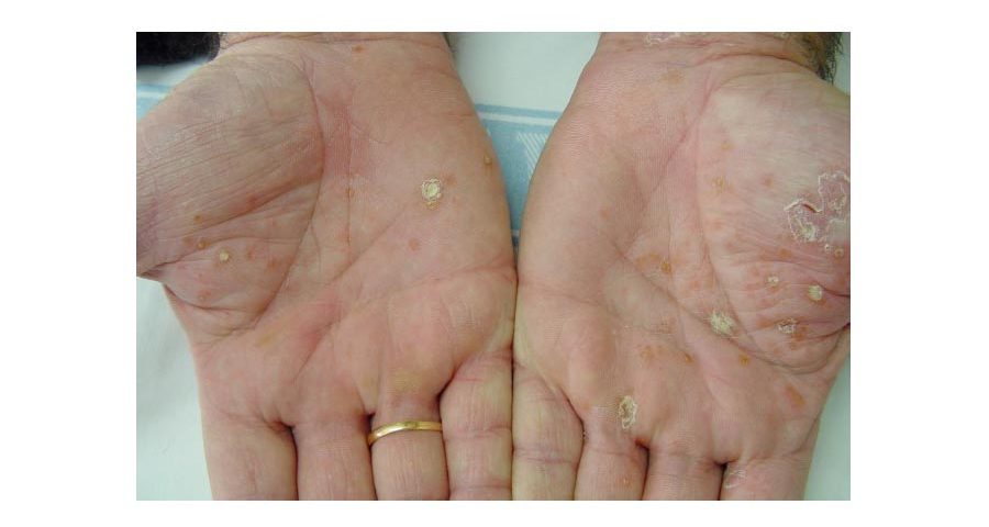 puede el uso de guantes de goma causar sequedad en las manos
