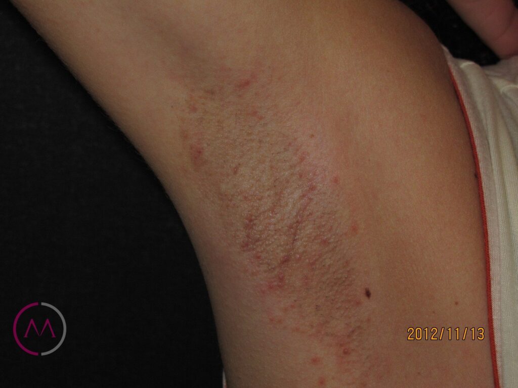 puede la crema post depilatoria causar alergias en la piel