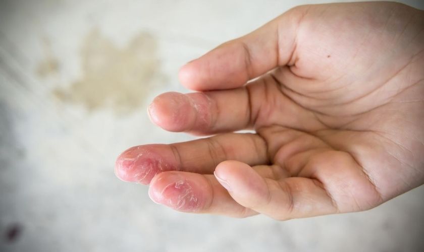 pueden las cremas para manos causar irritacion en la piel