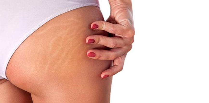 que es lo mejor para las estrias blancas